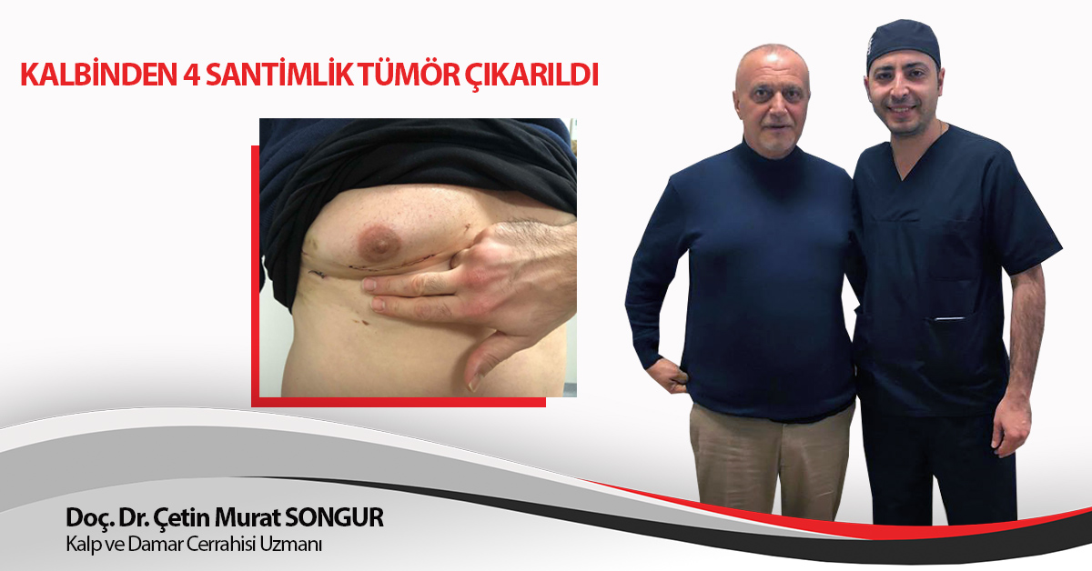 KALBİNDEN 4 SANTİMLİK TÜMÖR ÇIKARILDI